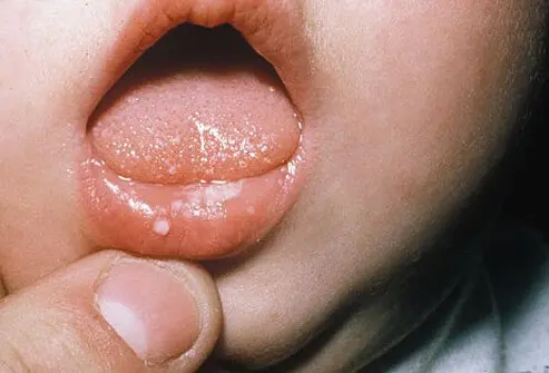 Picture of Baby Yeast Infections