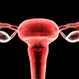 Uterine Fibroids Quiz